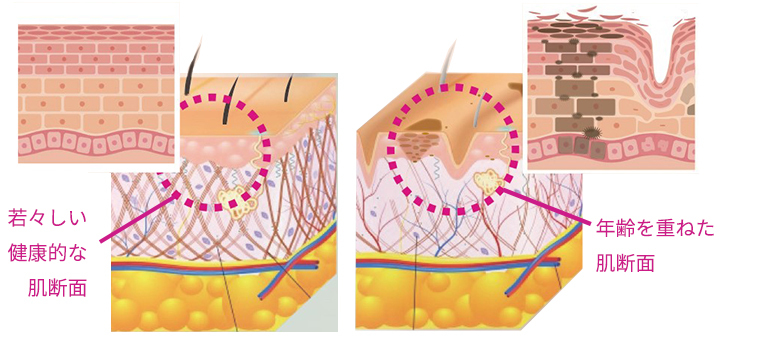 若々しい肌の断面と年齢を重ねた肌の断面図
