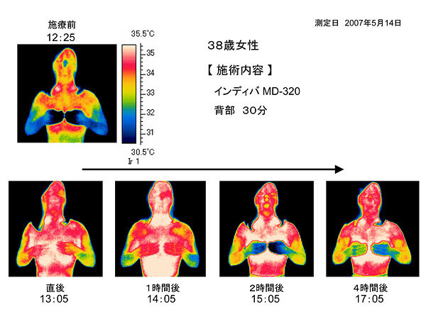 38歳女性のインディバMD-320施術後サーモグラフィ